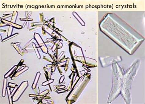 Struvite crystals | Medical Laboratories