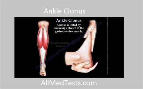 To Demonstrate Ankle and Patellar Clonus On a Subject - All Medical Tests