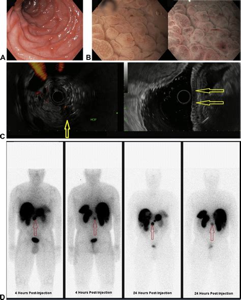 Classical features of Zollinger-Ellison syndrome, in images - Gastrointestinal Endoscopy