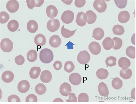 Schistocytes • The Blood Project