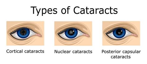 Are there different types of cataract? What can the tell us?