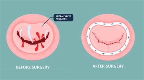 Mitral Valve Repair: Different Approaches for Patients