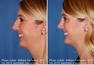 Flat Nose Before and After Photo Gallery - Nose Surgery Photos