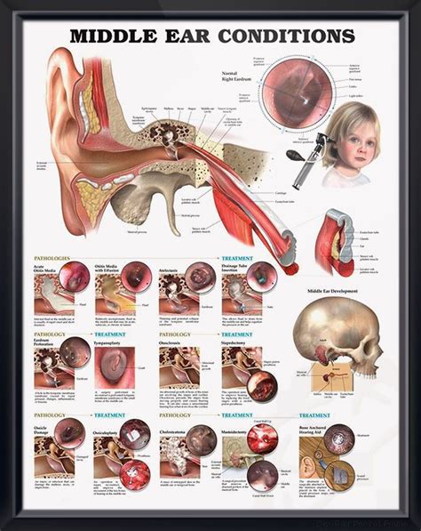 Middle Ear Conditions Chart 20x26 | Middle ear, Ear anatomy, Medical posters