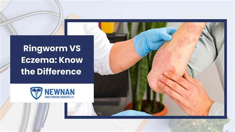 Ringworm VS Eczema: Know the Difference