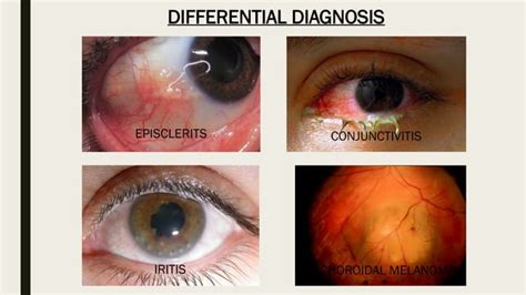 Episcleritis & Scleritis (causes, clinical features, treatment).pptx