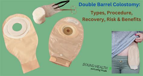 Double Barrel Colostomy: Types, Procedure, Recovery, Risk & Benefits ...