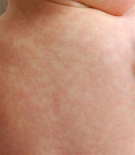 File:Amoxicillin rash 26 hours after 17th dose.JPG - Wikimedia Commons