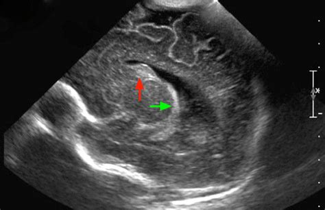 Germinal Matrix Hemorrhage Ultrasound