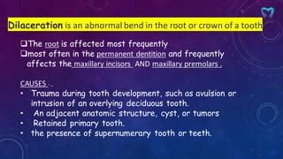 Dilaceration pdf | PPT