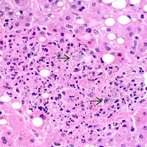 Histoplasmosis | Basicmedical Key