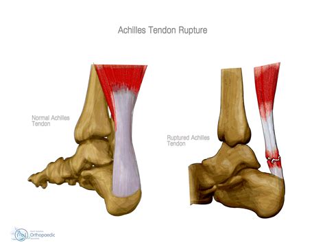 Achilles Rupture | Orthopaedic - Adam Budgen