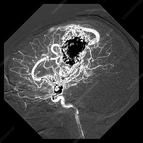 Cerebral Angiogram of AVM - Stock Image - C027/1581 - Science Photo Library