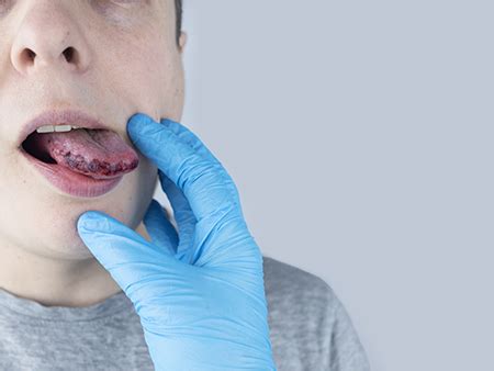 Dark spots on the tongue - Symptoms, Causes, and Treatments