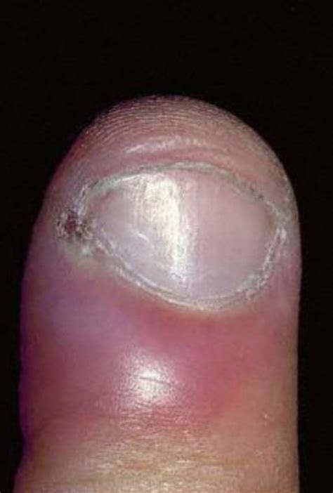 Understanding Paronychia: Fingernail Infection - Raleigh Hand to Shoulder Center | Raleigh Hand ...