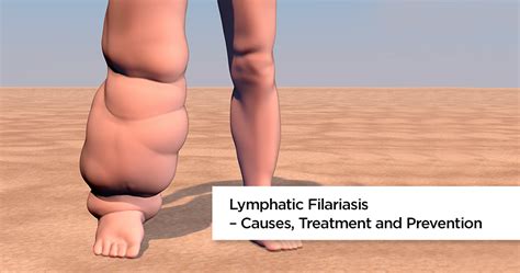 Elephantiasis | Lymphatic Filariasis | Filariasis Causes