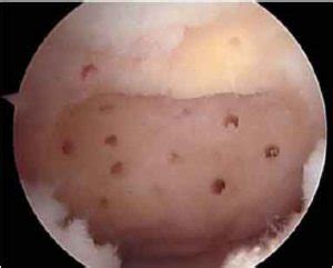 Microfracture Chondroplasty | Bone and Spine