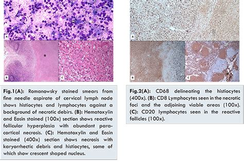 Kikuchi-Fujimoto Disease: A Sinister Morphology Having a Benign Course