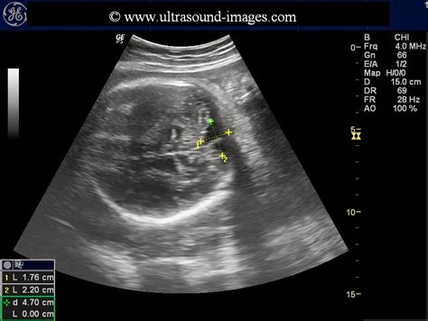 Ultrasound imaging: prominent fetal cisterna magna or more ominous?