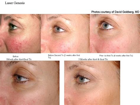 Laser Genesis Skin Rejuvenation | Face R-X Medspa