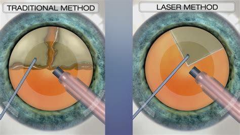 Cataract Treatment Options | Lasik Cataract Centre