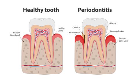 What are some secondary effects of Periodontitis? Dental Health Centers ...