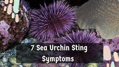 7 Sea Urchin Sting Symptoms: Understanding, Treatment, & Prevention ...