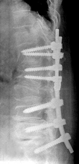 Spinal fusion with pedicle screw fixation and pedicle subtraction... | Download Scientific Diagram