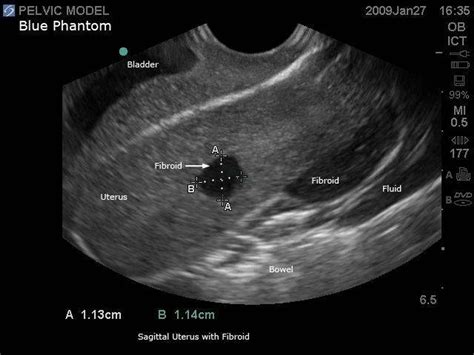 General Pathology Transvaginal Ultrasound Training Model