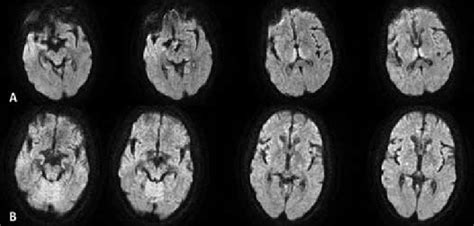 A) Axial DWI from the first contrast-free MRI of the patient shows... | Download Scientific Diagram