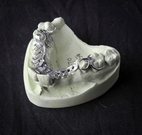 Chrome Cobalt and Titanium Metal Framework Dentures - McNally Denture ...