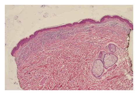 Intradermal atypical nevus cells in the left part of the biopsy ...