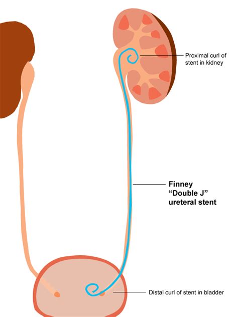 A brief history of ureteral stents - KidneyStoners.org