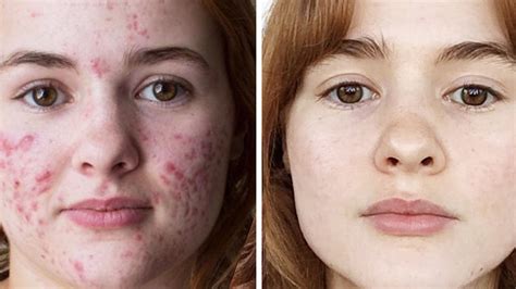 Accutane Before And After Bacne