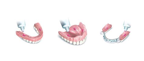 Polident Denture Adhesive | Haleon HealthPartner