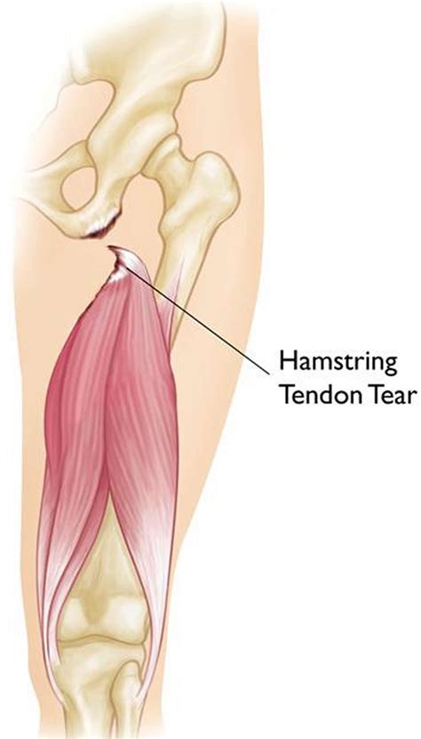 Hamstring Injury - Causes, Symptoms, Recovery Time & Treatment