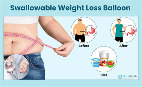 Swallowable Weight Loss Balloon: Procedure, Benefits, Risks