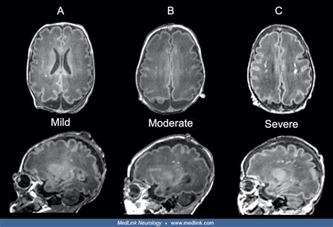 Neonatal white matter injury | MedLink Neurology