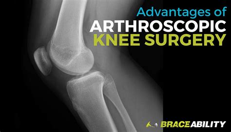 Benefits of Arthroscopic Knee Surgery | Cost & Laparoscopic Recovery