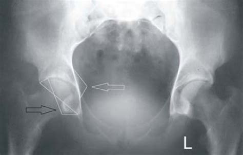 Standardized anteroposterior x-ray of the hips showing bilaterally ...