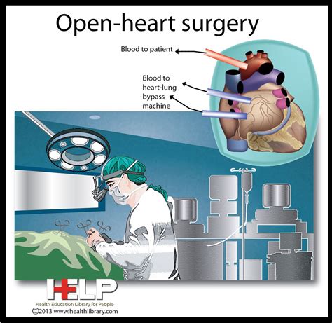 Open-Heart Surgery | Open heart surgery, Heart surgery, Medical careers