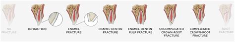 Luxation injury: Lateral luxation – Dental Trauma Guide