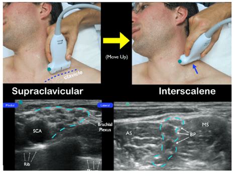 Ultrasound-Guided Interscalene Brachial Plexus Nerve Block – Core EM