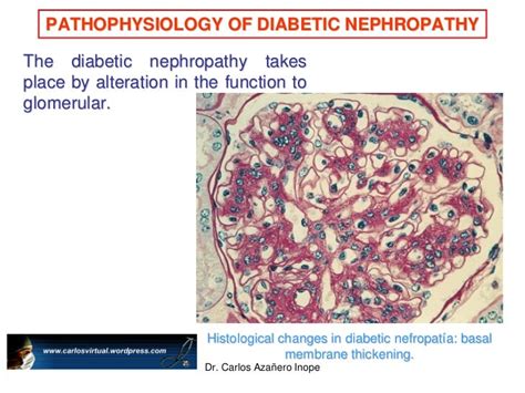 PATHOPHYSIOLOGY OF DIABETIC NEPHROPATHY