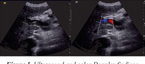 Portal Vein Thrombosis Ultrasound