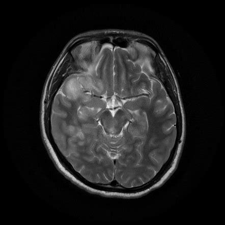 Diffuse axonal injury (grading) | Radiology Reference Article ...