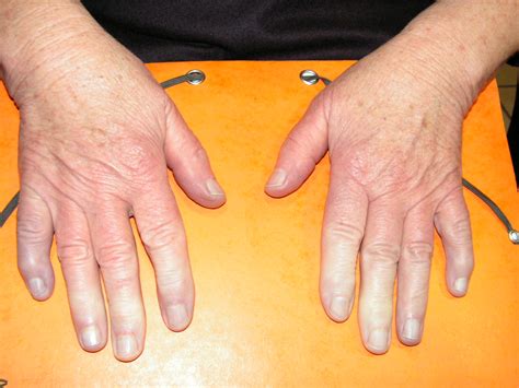 File:Syndrome de Raynaud.JPG - Wikimedia Commons