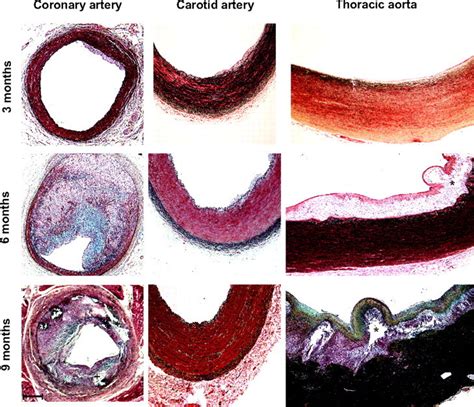 Site-Specific Atherogenic Gene Expression Correlates With Subsequent Variable Lesion Development ...