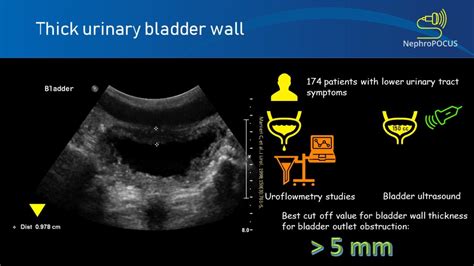 Urinary bladder wall thickness: what is the number to remember? – NephroPOCUS