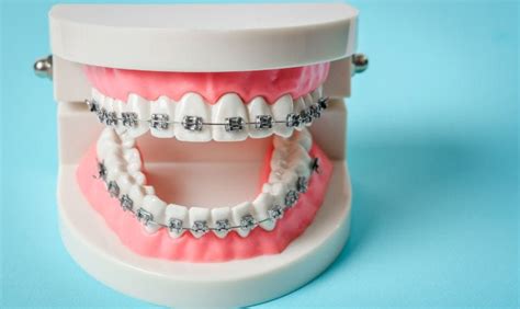 Metal Braces for Adults: Breaking the Stigma | by Grant Orthodontics | Medium